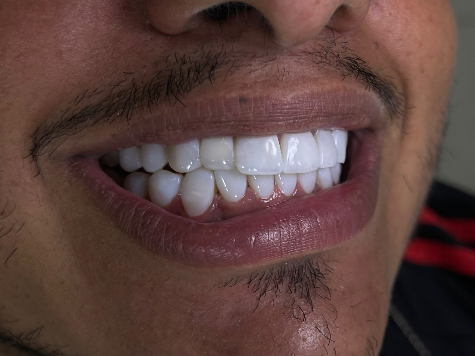 Caso 1 — Reconstrução do sorriso — depois