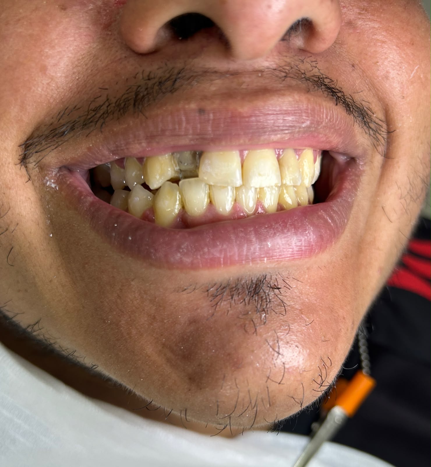 Caso 1 — Reconstrução do sorriso — antes
